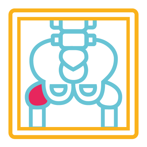 Artícula Coxofemoral Unilateral